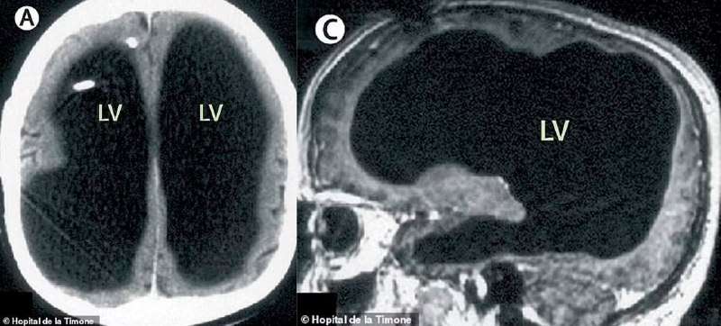 Чудные новости: француз 44 года жил без мозгов (почти). - новости