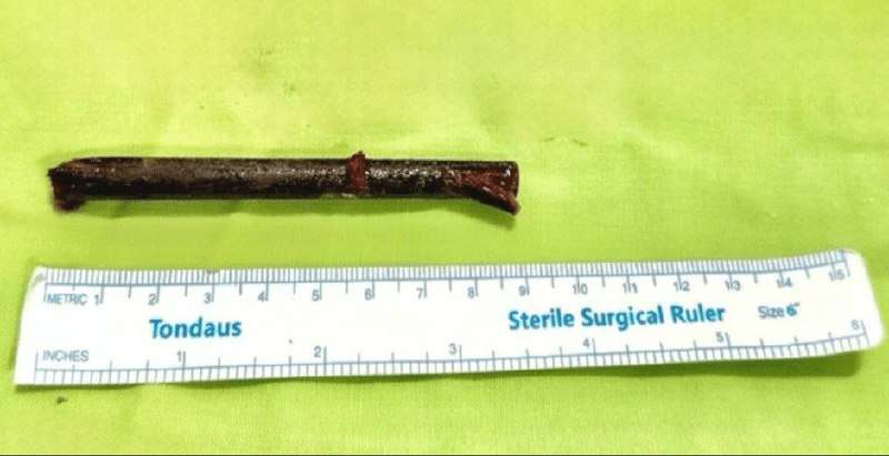 Вьетнамская сюрприз-история: палочка, которая застряла в глазнице – просто экзотика! 🎉 - новости